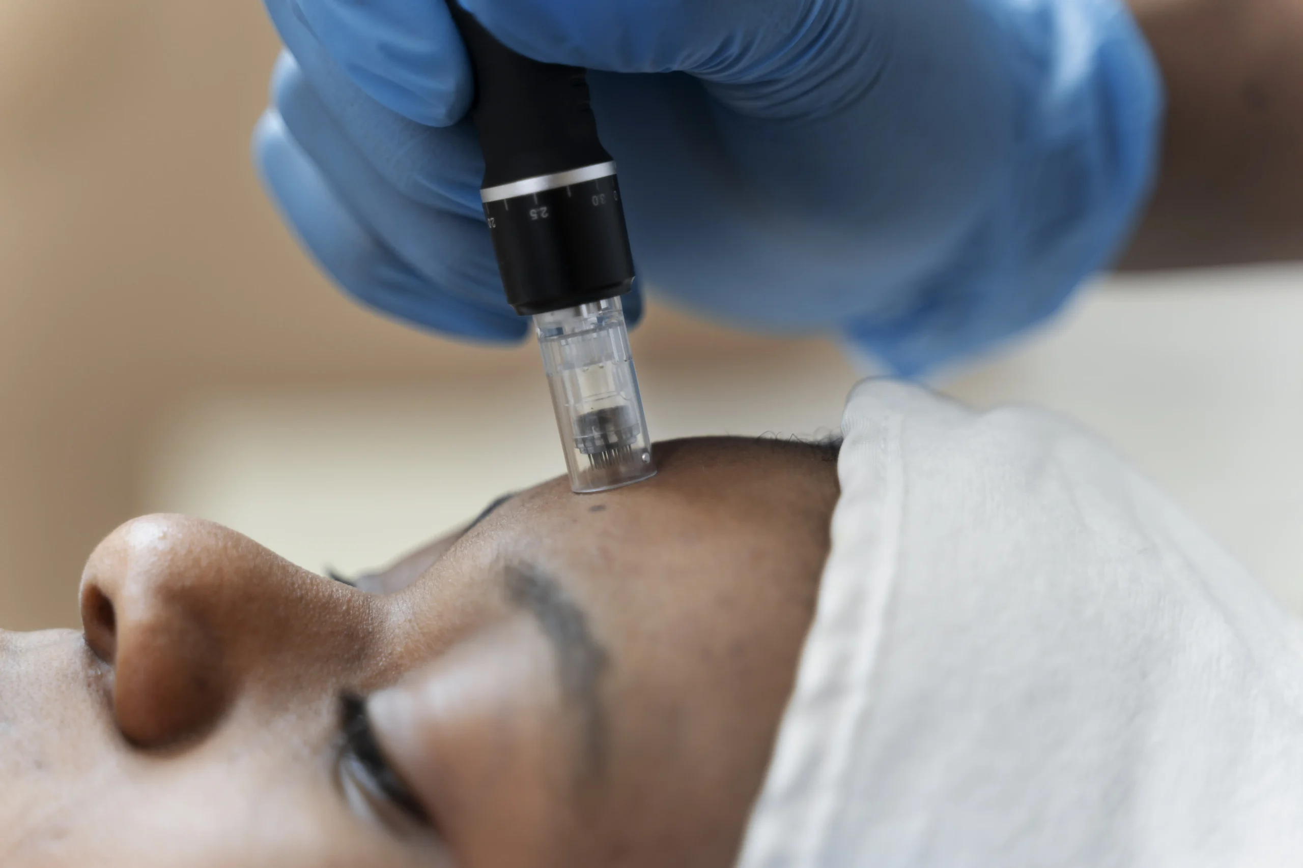 person-getting-micro-needling-beauty-treatment